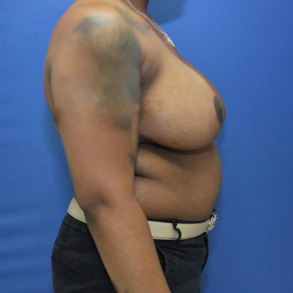 after breast reduction with breast lift right side view case 1532