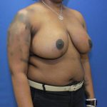 after breast reduction with breast lift right angle view case 1532