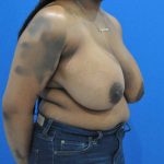 before breast reduction with breast lift right angle view case 1532