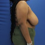 before breast reduction with lift right side female case 1543