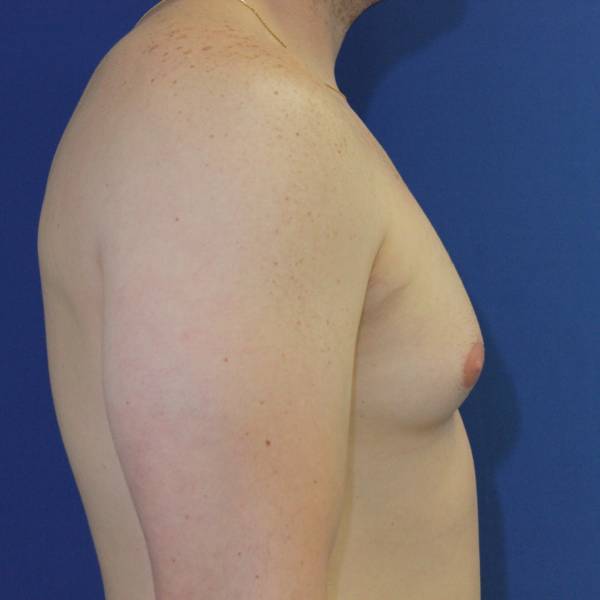 before gynecomastia surgery right side case 1379