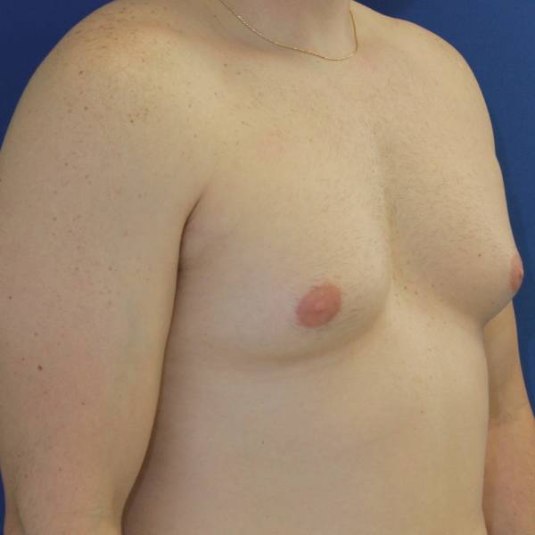 before gynecomastia surgery right angle case 1379