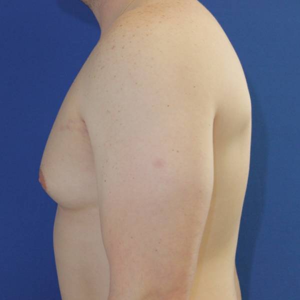 before gynecomastia surgery left side case 1379