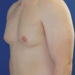 before gynecomastia surgery left angle case 1379