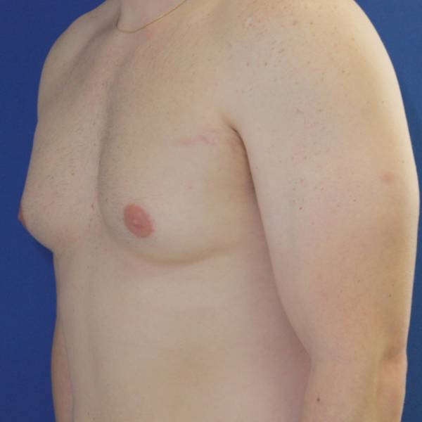 before gynecomastia surgery left angle case 1379