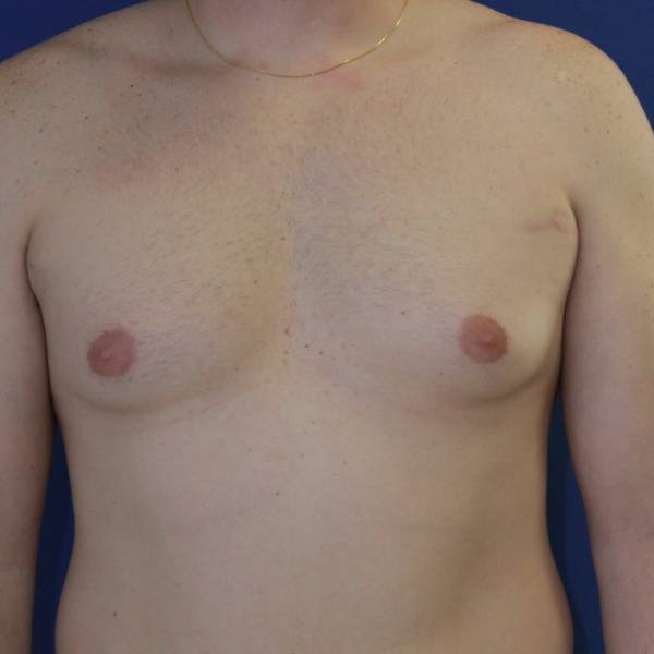 before gynecomastia surgery front view case 1379