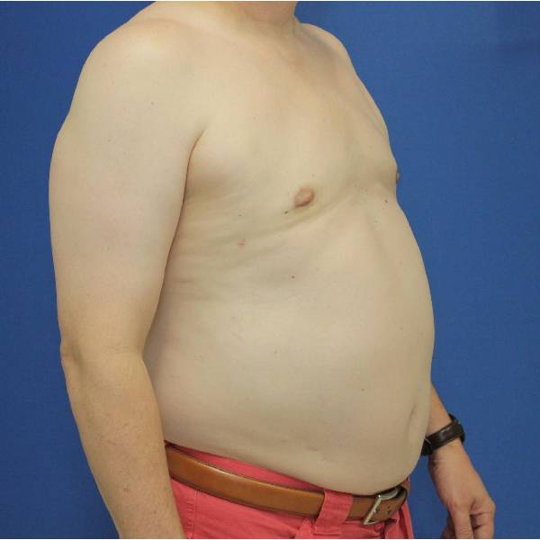 after gynecomastia surgery right angle view case 1390