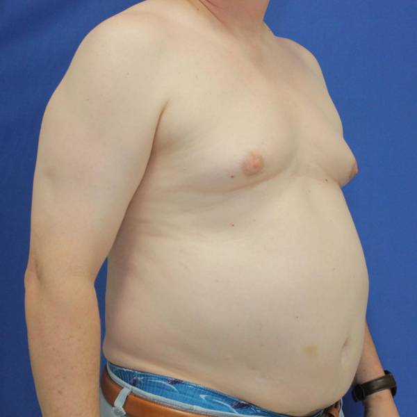 before gynecomastia surgery right angle view case 1390