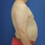 after gynecomastia surgery right side case 1390