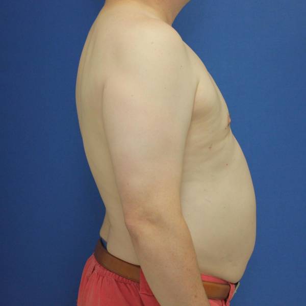after gynecomastia surgery right side case 1390