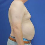 before gynecomastia surgery right side case 1390