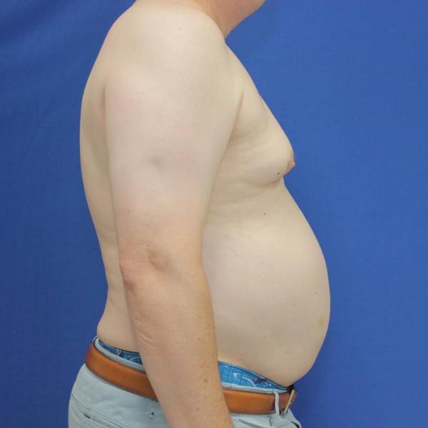 before gynecomastia surgery right side case 1390