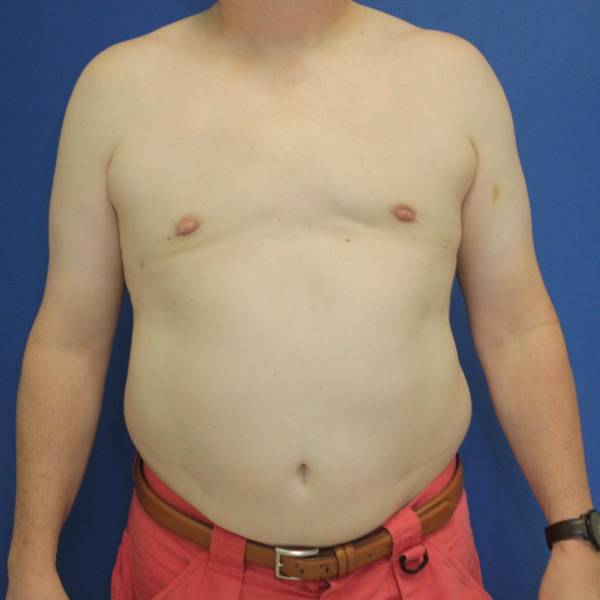 after gynecomastia surgery front view case 1390