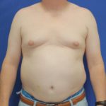 before gynecomastia surgery front view case 1390