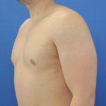 after gynecomastia left angle view case 1379
