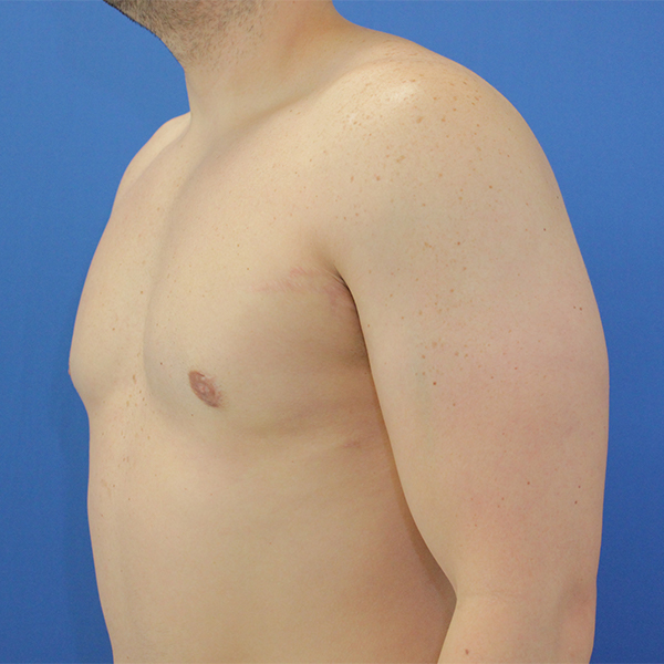 after gynecomastia left angle view case 1379