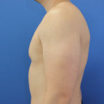 after gynecomastia left side view case 1379