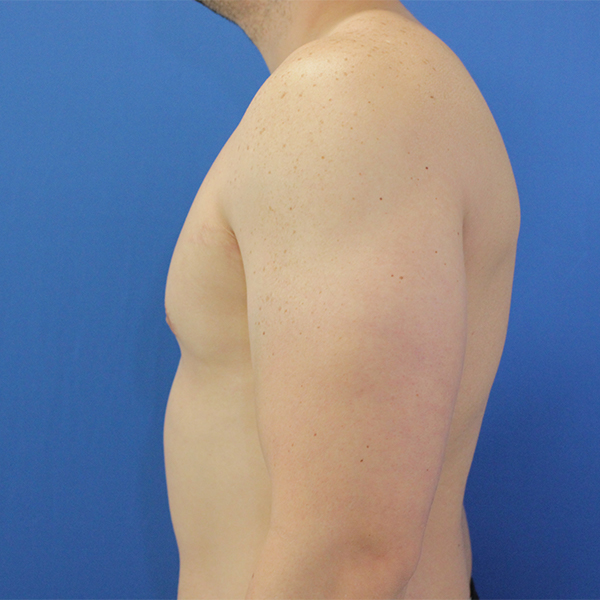 after gynecomastia left side view case 1379