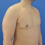 after after gynecomastia right angle view case 1379