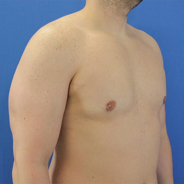 after after gynecomastia right angle view case 1379