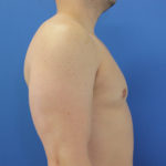 after gynecomastia right side view case 1379