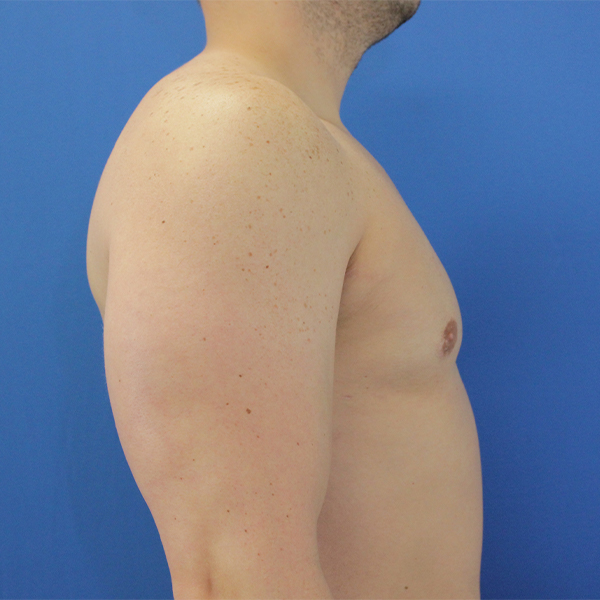 after gynecomastia right side view case 1379