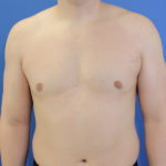 after gynecomastia front view case 1379