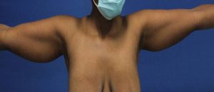before Liposuction front view Case 1092