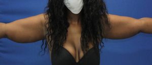 after Liposuction front view Case 1092