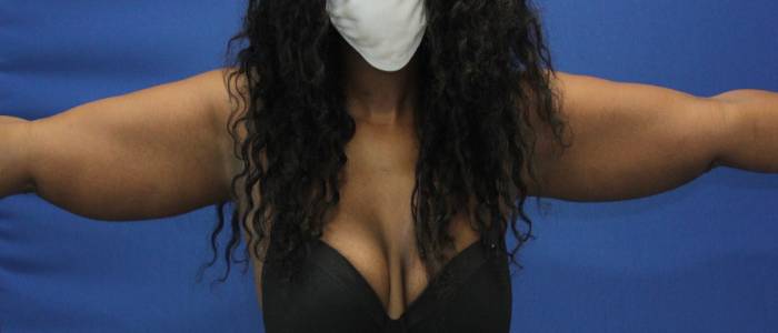after Liposuction front view Case 1092