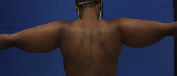 before Liposuction back view Case 1092