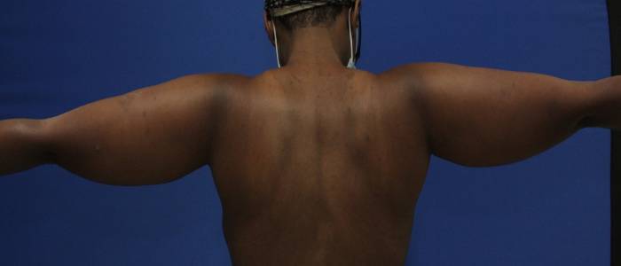 before Liposuction back view Case 1092