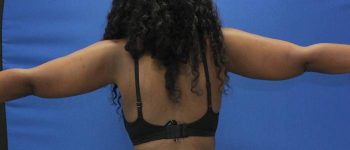 after Liposuction back view Case 1092