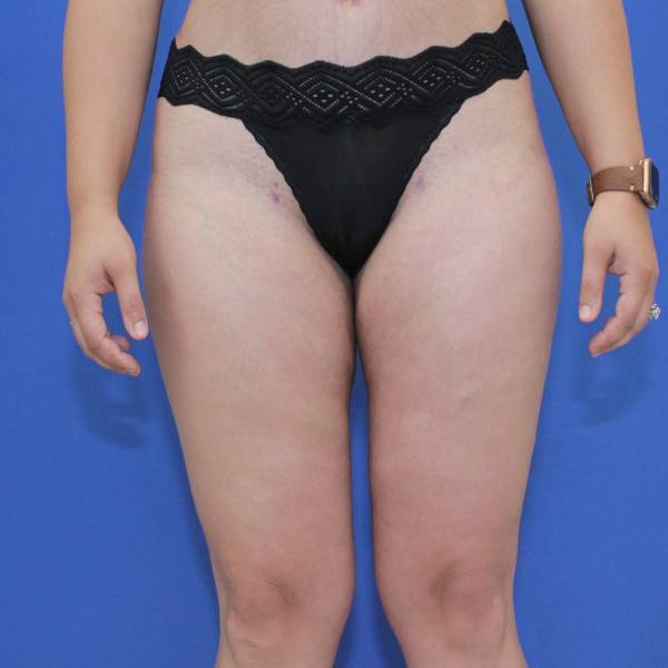 after Liposuction front view Case 1107