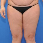 before Liposuction front view Case 1107