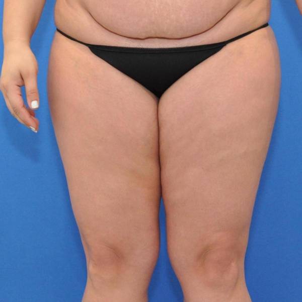 before Liposuction front view Case 1107