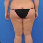 before Liposuction back view Case 1107