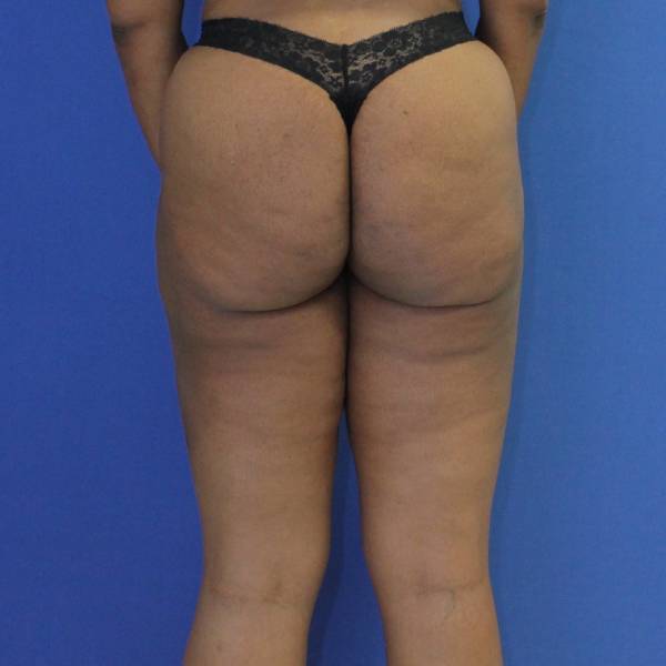 after Liposuction back view Case 1112