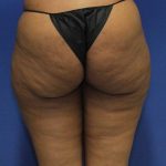 before Liposuction back view Case 1112
