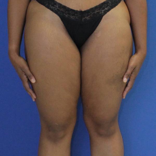 after Liposuction front view Case 1112