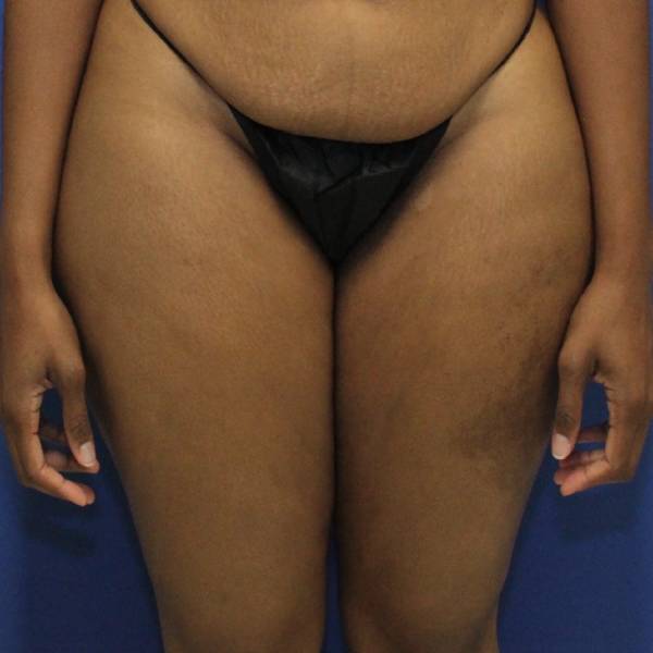 before Liposuction front view Case 1112