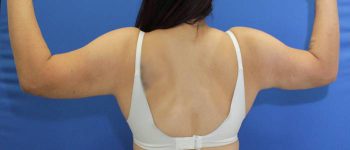 after arm liposuction female patient back view arms up case 1102