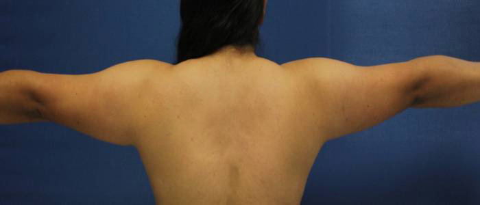 before arm liposuction female patient back view case 1102
