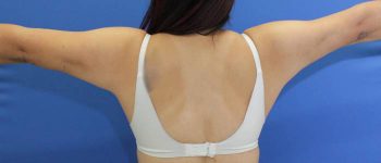 after arm liposuction female patient back view case 1102