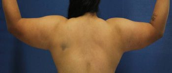 before arm liposuction back view female case 1102