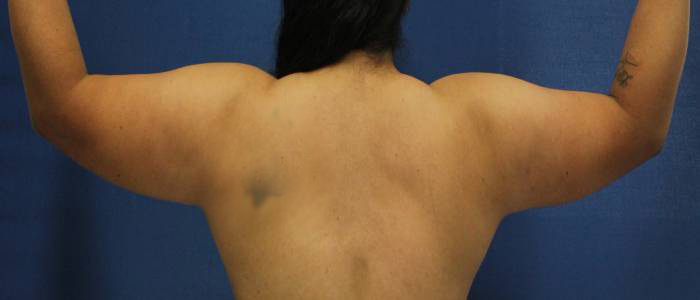 before arm liposuction back view female case 1102
