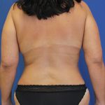 after mommy makeover back view Case 862