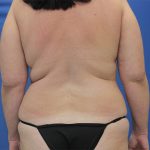 before mommy makeover back view Case 862