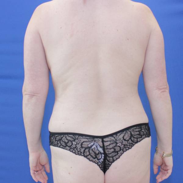 after mommy makeover back view Case 871