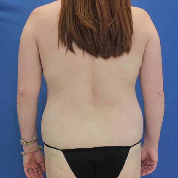 before mommy makeover back view Case 871